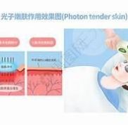 北京通州潞河醫(yī)院光子嫩膚體驗分享