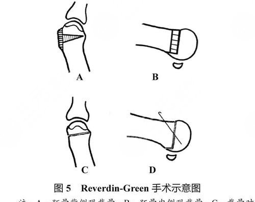 大腳骨手術過程圖分享