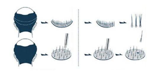 FUT還是FUE-哪種頭發(fā)移植適合你