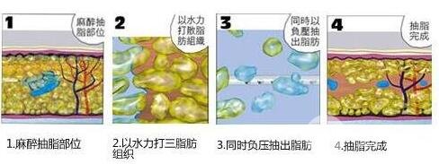 360水動力吸脂減肥價格和對比圖