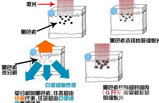 激光美容祛斑價格是多少