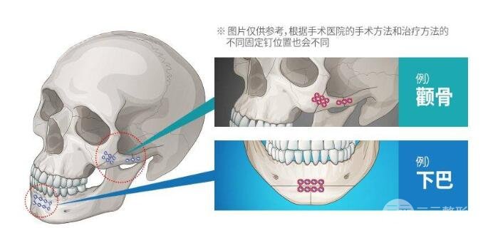 顴骨內(nèi)推和磨骨手術(shù)的區(qū)別