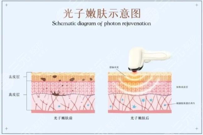 光子嫩膚一般多少錢一療程