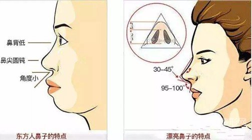 去除鼻唇溝方法不只有填充