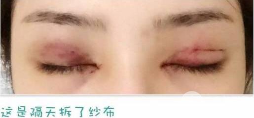 開眼角前后對比照片