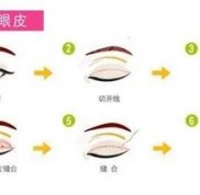 唐山雙眼皮哪家醫(yī)院做的好