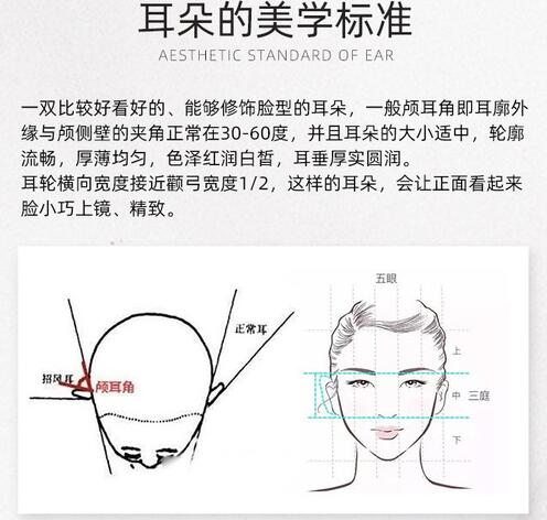 貼面耳or招風(fēng)耳