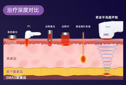 半島超聲泡果怎么樣