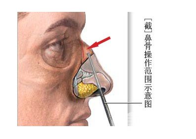 鼻骨內(nèi)推失敗會怎么樣