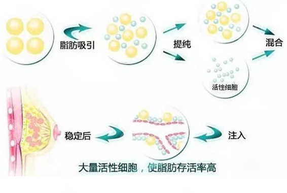 郑州天后隆胸怎么样