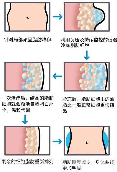 注射注射溶脂減肥是捷徑