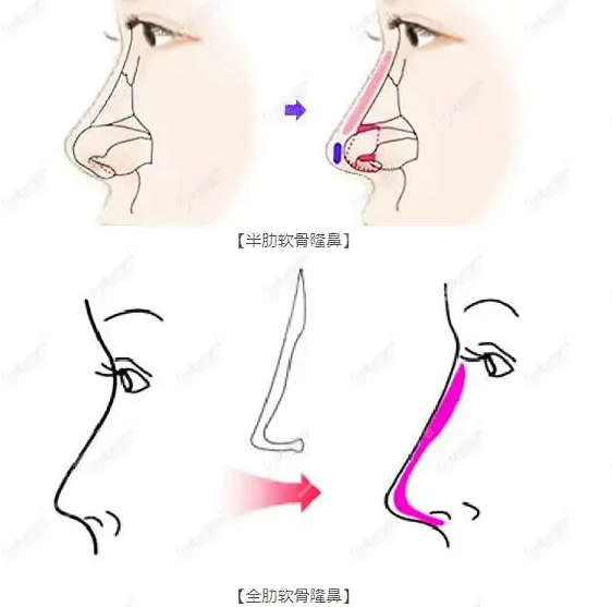 鼻子做了半個(gè)月可以取出來嗎