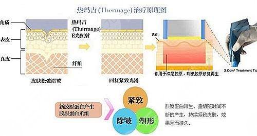 上海九院熱瑪吉做得如何