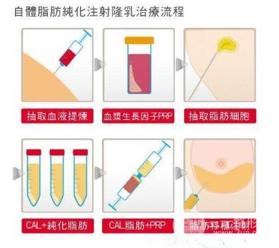 自體脂肪填充是長久的嗎