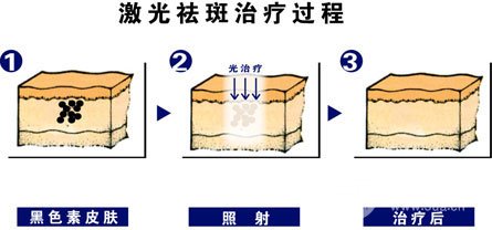 激光祛斑果好不好