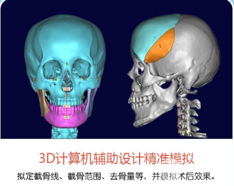 削骨手术怎么做