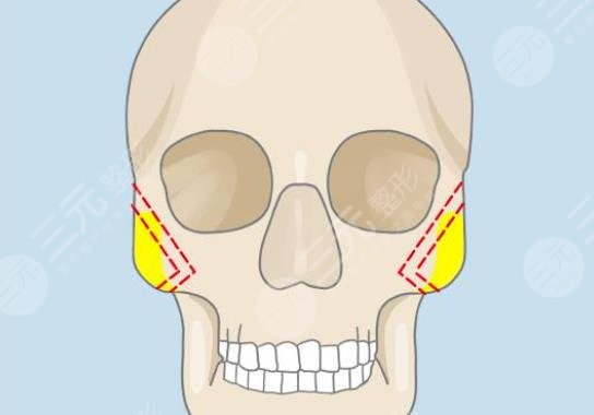 顴骨內(nèi)推手術(shù)全過(guò)程揭秘