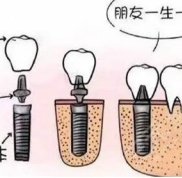 廈門種牙哪家醫(yī)院好