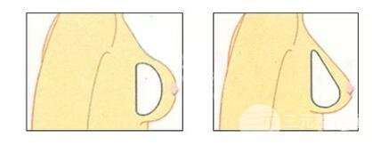 假體豐胸要多少費(fèi)用是多少錢