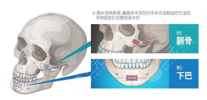 首尔丽格磨骨哪个医生好