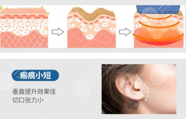 拉皮手術(shù)會(huì)不會(huì)傷到神經(jīng)