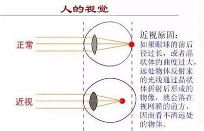 眼睛做激光手术有什么后遗症