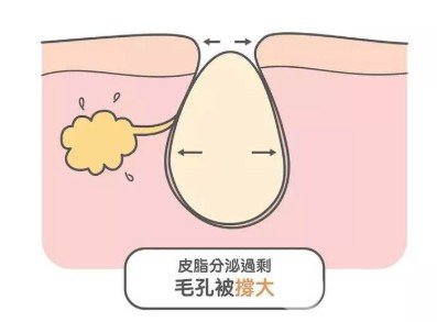 男生皮膚粗糙如何改善