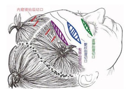 小切口除皺術(shù)比大拉皮好嗎