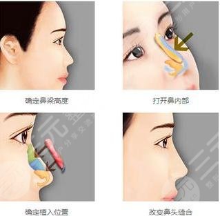 上海隆鼻专家