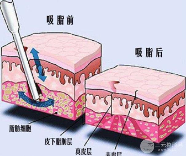 光纖溶脂瘦大腿果怎么樣