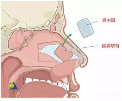 鼻中隔软骨隆鼻的优势和劣势