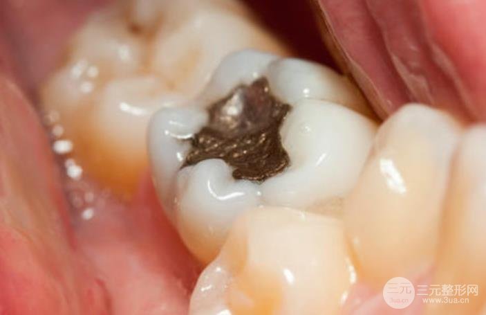 牙根发黑可能是由牙根表面龋齿引起的