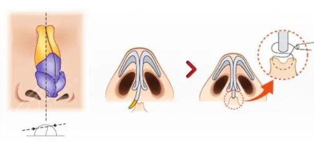 膨体隆鼻可以维持多少年