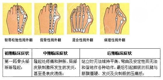 大腳骨手術(shù)過程圖分享