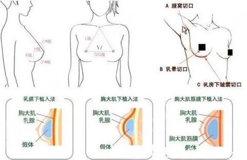 綿陽中心醫(yī)院可以隆胸嗎