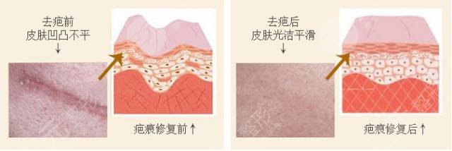 激光祛疤結(jié)痂圖片過程