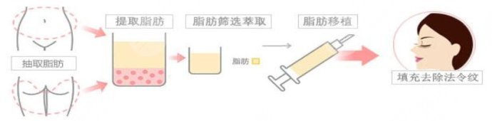 改善法令紋的醫(yī)美項目有哪些