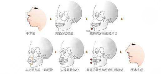 北京正颌手术费用一般是多少钱