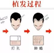 無錫發(fā)際線種植十大醫(yī)院排行榜公布