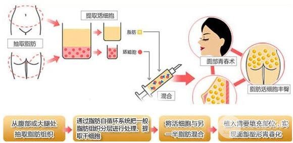 北京东方和谐医院专家谈自体脂肪填充的利弊