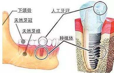 上海哪里种牙性价比高