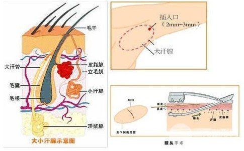 狐臭怎么基本去除