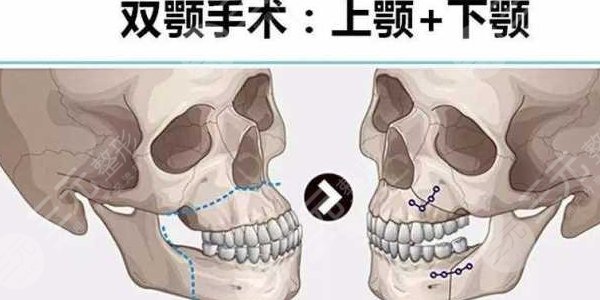 正颌手术老得快是事实还是谣言