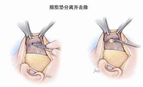 面部頰脂墊位置圖分解圖