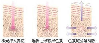 激光美白嫩膚價(jià)格是多少