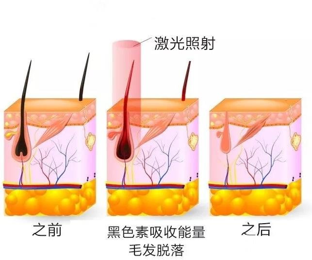 彩光脫毛有副作用嗎