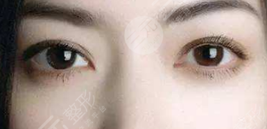 北京微创双眼皮手术体验分享