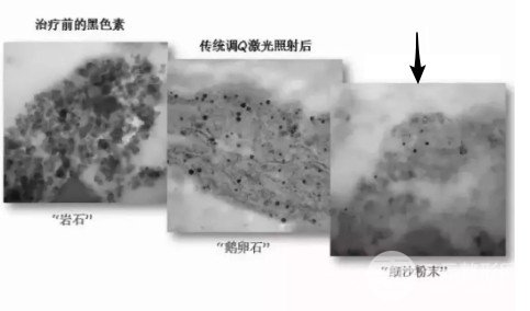 超蜂巢祛斑會(huì)反彈嗎