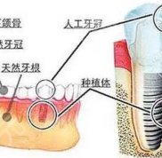 珠海人民醫(yī)院口腔科種植牙好不好