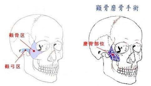 顴骨降低術(shù)原理圖文分析